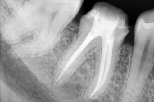 endodoncija